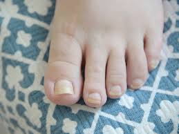 thick toenails diagnosis pictures