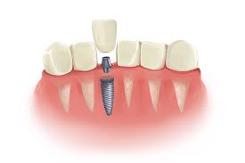 the truth about dental implants why