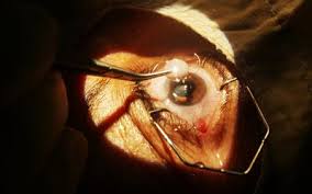 laser surgery for cataracts prep