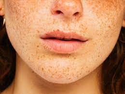 black spots on lips 11 causes