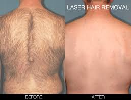 laser hair removal procedure in toronto