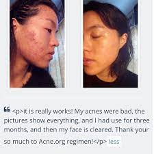 acne org regimen set beauty personal