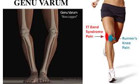 diagnosing lateral thigh pain it band