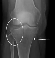 knee tibial plateau fracture aoa