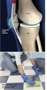 prepatellar bursitis kneecap bursitis