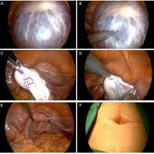 Instead, it grows and becomes a cyst. A Large Ovarian Cyst 10 Cm In Diameter B Aspiration Of Cystic Download Scientific Diagram