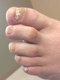 is toenail fungus conious the