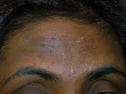 treating acne in skin of color