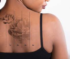 Using this method for larger tattoos can be more difficult when it comes to replacing the lost skin; Tattoo Removal Skin101 Center