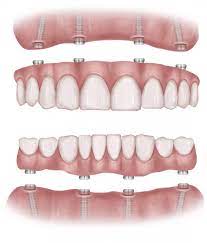 Free dental implants for low income uk. All On 4 Dental Implants Kent All On 4 Cost Fr 1 70 P D Same Day Teeth