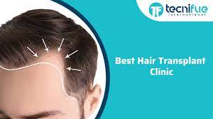 best hair transplant clinic tecnifue