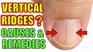 vertical ridges on your nails