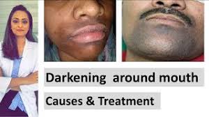 darkening around mouth causes