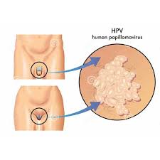 hpv warts treatment in