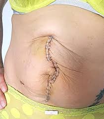 Prior uterine scar, usually a previous cesarean section scar, and that a classic cesarean section scar goes through uterine muscle and is more likely to dehisce than a low transverse cesarean. Sarah Cawood Reveals Her C Section Scar Nearly Killed Her After Her Internal Organs Turned Septic Mirror Online
