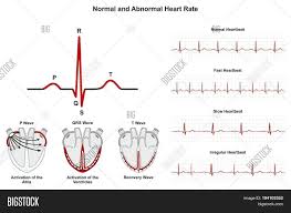 Normal Abnormal Heart Image Photo Free Trial Bigstock