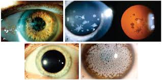 Corneal dystrophies are a group of relatively rare genetic eye disorders in which abnormal material with corneal dystrophies, abnormal material builds up in the cornea (the clear, front window of the eye). The Ic3d Classification Of The Corneal Dystrophies Abstract Europe Pmc