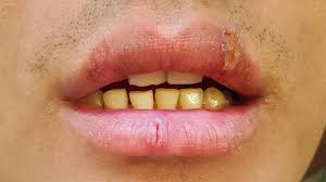 chapped lips cheilitis simplex