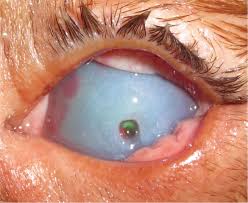 the veterinary nurse corneal ulcers