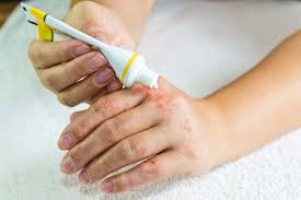 eczema symptoms causes and treatments