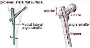 proximal fem nail antirotation asia