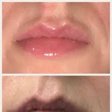 upper lip after filler