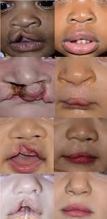 primary cleft lip repair