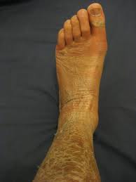 an ankle fracture with exercise