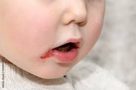 lip child with cold sores