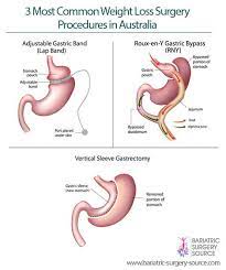The wide variation is due to many factors. Weight Loss Surgery Australia All You Need To Know Bariatric Surgery Source