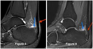 The subacromial impingement syndrome of the conflict (impingment syndrome). Minimally Invasive Achilles Haglund S Syndrome And Endoscopic Calcaneoplasty Orthovirginia