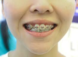 Recently i've been looking online for a good tutorial on how to make fake braces. Fake Dentists Are Making A Comeback At The Unlikeliest Of Places The Star