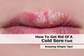 relief for cold sore sufferers new