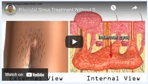 pilonidal sinus surgery latest techniques