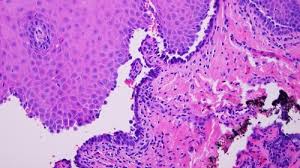 mucosa lesions and pathology