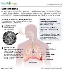 Pleural mesothelioma occurs in the lining of the lung and accounts for approximately 75 percent of all cases. Pin On Mesothelioma