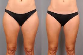 thigh liposuction in mahattan new york