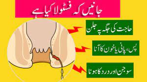 fistula in urdu fistula causes
