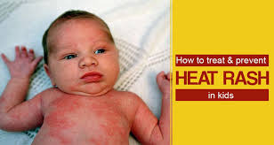 home remes for heat rashes in kids