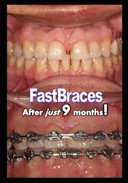 The retainer will do an amazing job of forcing the teeth back so that they do not flare out and cause you to feel bad about. Close Those Pesky Gaps Between Your Teeth With Fastbraces Gap Teeth Dental Care Teeth