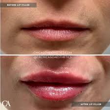 lip injections before after chicago