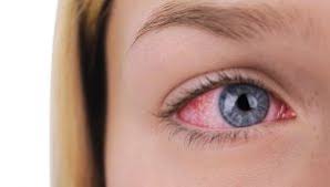 how to treat bloodshot eyes vizulize