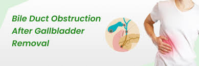 bile duct obstruction after gallbladder
