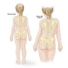juvenile scoliosis what you need to