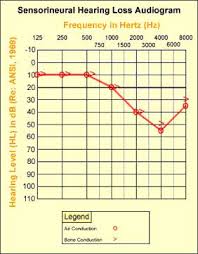 Interpreting Your Hearing Test Results The Audiogram