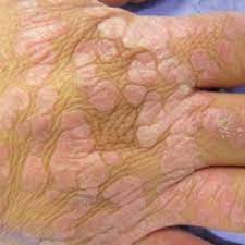 flat warts on the hands