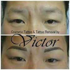 permanent makeup tattoo removal by