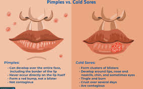 cold sores identification treatment