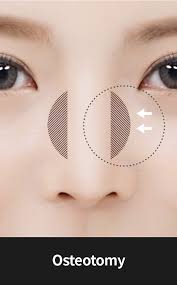 We did not find results for: Your Complete Guide On A Korean Nose Job Hyundai Aesthetics Blog