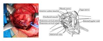 side supraclavicular lymph nodes